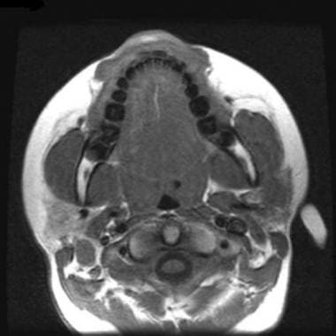снимок МРТ слюнных желез